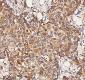 IHC staining of FFPE human breast cancer tissue with STIM1 antibody. HIER: boil tissue sections in pH8 EDTA for 20 min and allow to cool before testing.