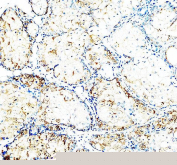 IHC staining of FFPE human teratoma tissue with CD24 antibody, HRP-labeled secondary and DAB substrate. HIER: boil tissue sections in pH8 EDTA for 20 min and allow to cool before testing.