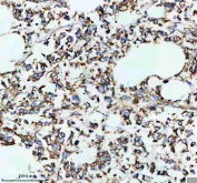 IHC staining of FFPE human breast cancer tissue with SLC16A1 antibody, HRP-secondary and DAB substrate. HIER: boil tissue sections in pH8 EDTA for 20 min and allow to cool before testing.