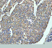 IHC staining of FFPE human cervical cancer tissue with SLC16A1 antibody, HRP-secondary and DAB substrate. HIER: boil tissue sections in pH8 EDTA for 20 min and allow to cool before testing.