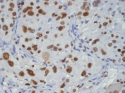 IHC staining of FFPE human glioma tissue with TAR DNA binding protein 43 antibody, HRP-secondary and DAB substrate. HIER: boil tissue sections in pH8 EDTA for 20 min and allow to cool before testing.