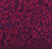 Immunofluorescent staining of FFPE human gastric cancer tissue with ME1 antibody (red) and DAPI nuclear stain (blue). HIER: steam section in pH8 EDTA buffer for 20 min.