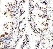 IHC staining of FFPE human prostate cancer tissue with Cyclin dependent kinase 9 antibody, HRP-secondary and DAB substrate. HIER: boil tissue sections in pH8 EDTA for 20 min and allow to cool before testing.