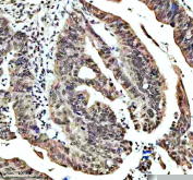 IHC staining of FFPE human colon cancer tissue with SHP2 antibody, HRP-secondary and DAB substrate. HIER: boil tissue sections in pH8 EDTA for 20 min and allow to cool before testing.