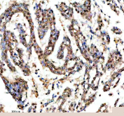 IHC staining of FFPE human lung cancer tissue with SHP2 antibody, HRP-secondary and DAB substrate. HIER: boil tissue sections in pH8 EDTA for 20 min and allow to cool before testing.