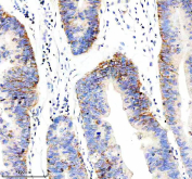 IHC staining of FFPE human stomach cancer tissue with PRKCH antibody, HRP-secondary and DAB substrate. HIER: boil tissue sections in pH8 EDTA for 20 min and allow to cool before testing.