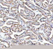 IHC staining of FFPE human thyroid cancer tissue with PRKCH antibody, HRP-secondary and DAB substrate. HIER: boil tissue sections in pH8 EDTA for 20 min and allow to cool before testing.