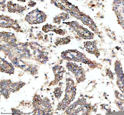 IHC staining of FFPE human lung cancer tissue with MYO7A antibody, HRP-secondary and DAB substrate. HIER: boil tissue sections in pH8 EDTA for 20 min and allow to cool before testing.