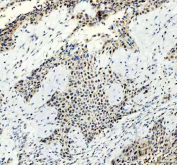 IHC staining of FFPE human lung cancer tissue with ATRIP antibody, HRP-secondary and DAB substrate. HIER: boil tissue sections in pH8 EDTA for 20 min and allow to cool before testing.