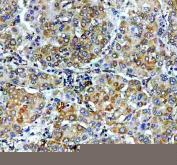 IHC staining of FFPE human liver cancer tissue with VASP antibody, HRP-secondary and DAB substrate. HIER: boil tissue sections in pH8 EDTA for 20 min and allow to cool before testing.