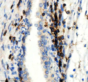 IHC staining of FFPE human prostate cancer tissue with CD247 antibody, HRP-secondary and DAB substrate. HIER: boil tissue sections in pH8 EDTA for 20 min and allow to cool before testing.