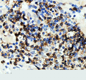 IHC staining of FFPE human prostate cancer tissue with CD247 antibody, HRP-secondary and DAB substrate. HIER: boil tissue sections in pH8 EDTA for 20 min and allow to cool before testing.