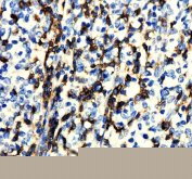 IHC staining of FFPE human lymphoma tissue with CD247 antibody, HRP-secondary and DAB substrate. HIER: boil tissue sections in pH8 EDTA for 20 min and allow to cool before testing.