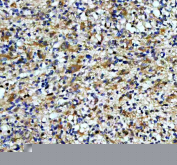 IHC staining of FFPE human glioma tissue with CAMK2 antibody, HRP-secondary and DAB substrate. HIER: boil tissue sections in pH8 EDTA for 20 min and allow to cool before testing.