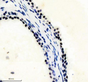 IHC staining of FFPE human prostate cancer tissue with PHF8 antibody, HRP-secondary and DAB substrate. HIER: boil tissue sections in pH8 EDTA for 20 min and allow to cool before testing.