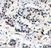 IHC staining of FFPE human stomach cancer tissue with PHF8 antibody, HRP-secondary and DAB substrate. HIER: boil tissue sections in pH8 EDTA for 20 min and allow to cool before testing.