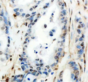 IHC staining of FFPE human pancreas cancer tissue with CIRBP antibody, HRP-secondary and DAB substrate. HIER: boil tissue sections in pH8 EDTA for 20 min and allow to cool before testing.