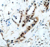 IHC staining of FFPE human pancreas cancer tissue with CIRBP antibody, HRP-secondary and DAB substrate. HIER: boil tissue sections in pH8 EDTA for 20 min and allow to cool before testing.