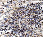 IHC staining of FFPE human glioma tissue with GAR1 antibody, HRP-secondary and DAB substrate. HIER: boil tissue sections in pH8 EDTA for 20 min and allow to cool before testing.