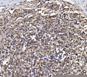 IHC staining of FFPE human gastric carcinoma tissue with GAR1 antibody, HRP-secondary and DAB substrate. HIER: boil tissue sections in pH8 EDTA for 20 min and allow to cool before testing.