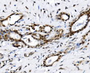 IHC staining of FFPE human breast cancer tissue with GAR1 antibody, HRP-secondary and DAB substrate. HIER: boil tissue sections in pH8 EDTA for 20 min and allow to cool before testing.