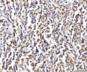 IHC staining of FFPE human lymphoma tissue with GAR1 antibody, HRP-secondary and DAB substrate. HIER: boil tissue sections in pH8 EDTA for 20 min and allow to cool before testing.