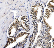 IHC staining of FFPE human prostate cancer tissue with GAR1 antibody, HRP-secondary and DAB substrate. HIER: boil tissue sections in pH8 EDTA for 20 min and allow to cool before testing.