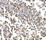 IHC staining of FFPE human pancreatic cancer tissue with GAR1 antibody, HRP-secondary and DAB substrate. HIER: boil tissue sections in pH8 EDTA for 20 min and allow to cool before testing.