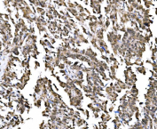 IHC staining of FFPE human ovarian adenoma tissue with GAR1 antibody, HRP-secondary and DAB substrate. HIER: boil tissue sections in pH8 EDTA for 20 min and allow to cool before testing.