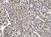 IHC staining of FFPE human liver cancer tissue with GAR1 antibody, HRP-secondary and DAB substrate. HIER: boil tissue sections in pH8 EDTA for 20 min and allow to cool before testing.