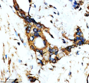 IHC staining of FFPE human pancreatic cancer tissue with YWHAQ antibody, HRP-secondary and DAB substrate. HIER: boil tissue sections in pH8 EDTA for 20 min and allow to cool before testing.