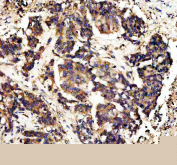 IHC staining of FFPE human colon cancer tissue with CAMK II alpha antibody, HRP-secondary and DAB substrate. HIER: boil tissue sections in pH8 EDTA for 20 min and allow to cool before testing.