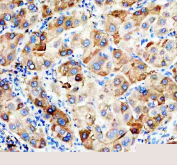 IHC staining of FFPE human liver cancer tissue with Apolipoprotein H antibody, HRP-secondary and DAB substrate. HIER: boil tissue sections in pH8 EDTA for 20 min and allow to cool before testing.