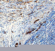 IHC staining of FFPE human diffuse large B-cell lymphoma of the intestine tissue with NES antibody, HRP-secondary and DAB substrate. HIER: boil tissue sections in pH8 EDTA for 20 min and allow to cool before testing.