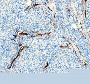 IHC staining of FFPE human non-small cell lung cancer tissue with NES antibody, HRP-secondary and DAB substrate. HIER: boil tissue sections in pH8 EDTA for 20 min and allow to cool before testing.