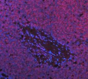 Immunofluorescent staining of FFPE human skin cancer tissue with DEAD box protein 1 antibody. HIER: boil tissue sections in pH8 EDTA for 20 min and allow to cool before testing.