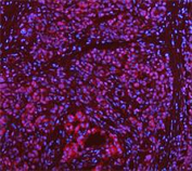 Immunofluorescent staining of FFPE human pancreas cancer tissue with DEAD box protein 1 antibody. HIER: boil tissue sections in pH8 EDTA for 20 min and allow to cool before testing.