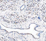 IHC staining of FFPE human pancreatic cancer tissue with DEAD box protein 1 antibody, HRP-secondary and DAB substrate. HIER: boil tissue sections in pH8 EDTA for 20 min and allow to cool before testing.