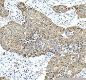 IHC staining of FFPE human liver cancer tissue with HPD antibody, HRP-secondary and DAB substrate. HIER: boil tissue sections in pH8 EDTA for 20 min and allow to cool before testing.