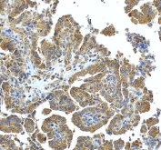 IHC staining of FFPE human ovarian cancer tissue with SNX6 antibody, HRP-secondary and DAB substrate. HIER: boil tissue sections in pH8 EDTA for 20 min and allow to cool before testing.