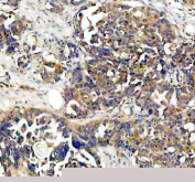 IHC staining of FFPE human ovarian cancer tissue with NQO1 antibody, HRP-secondary and DAB substrate. HIER: boil tissue sections in pH8 EDTA for 20 min and allow to cool before testing.
