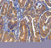 IHC staining of FFPE human colon cancer tissue with NQO1 antibody, HRP-secondary and DAB substrate. HIER: boil tissue sections in pH8 EDTA for 20 min and allow to cool before testing.