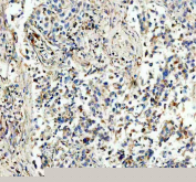 IHC staining of FFPE human lung cancer tissue with NDUFS1 antibody, HRP-secondary and DAB substrate. HIER: boil tissue sections in pH8 EDTA for 20 min and allow to cool before testing.