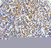 IHC staining of FFPE human thyroid cancer tissue with STXBP4 antibody, HRP-secondary and DAB substrate. HIER: boil tissue sections in pH8 EDTA for 20 min and allow to cool before testing.