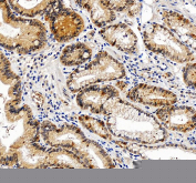 IHC staining of FFPE human stomach cancer tissue with POLR3D antibody, HRP-secondary and DAB substrate. HIER: boil tissue sections in pH8 EDTA for 20 min and allow to cool before testing.