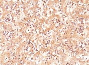 Alpha Fetoprotein antibody immunohistochemistry