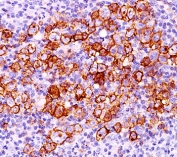 CD30 antibody CD30/412 immunohistochemistry 20X-2