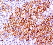 CD30 antibody CD30/412 immunohistochemistry 20X-1