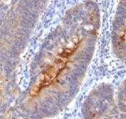 IHC testing of human colon carcinoma and Secretory Component antibody (SC05).
