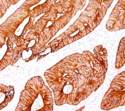 Cytokeratin 8 antibody K8/383 immunohistochemistry colon carcinoma